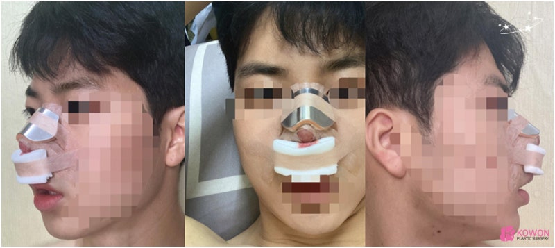 코성형병원 남자 복코전후 비교 사진 사진 3