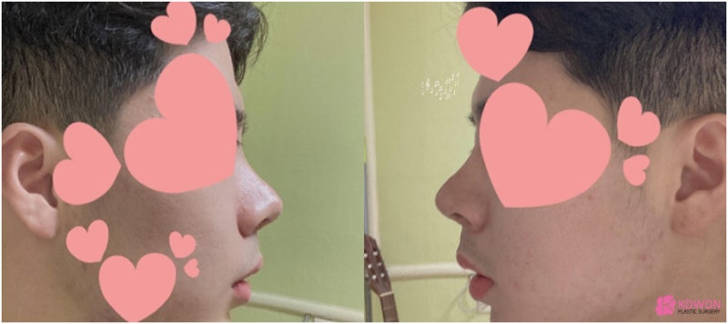 코성형병원 남자 복코전후 비교 사진 사진 6