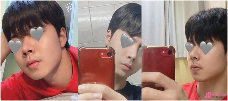 코성형병원 남자 복코전후 비교 사진 사진 10