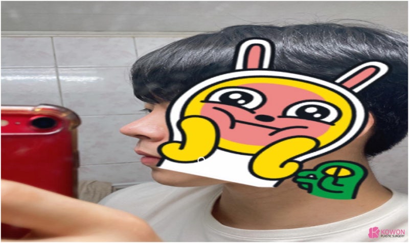 코성형병원 남자 복코전후 비교 사진