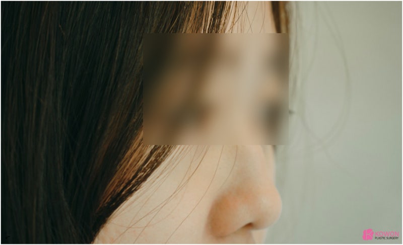 코수술후 붓기 쉽게 제거하는 노하우 사진 10