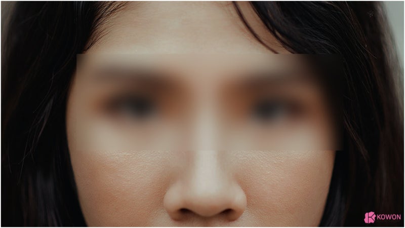 코수술후 붓기 쉽게 제거하는 노하우