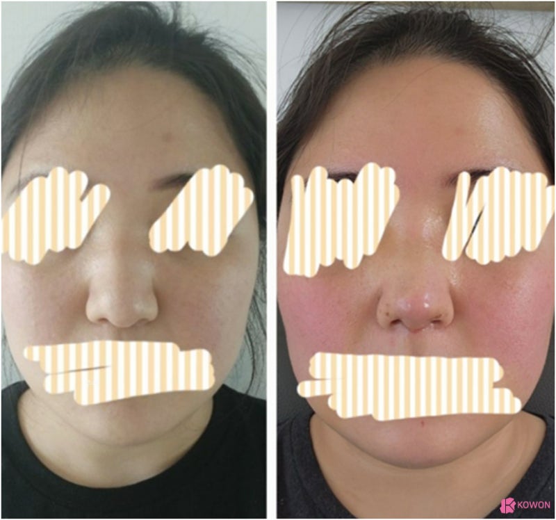 복코수술전후 코끝살 올리고 인중 라인까지 예쁘게 사진 8