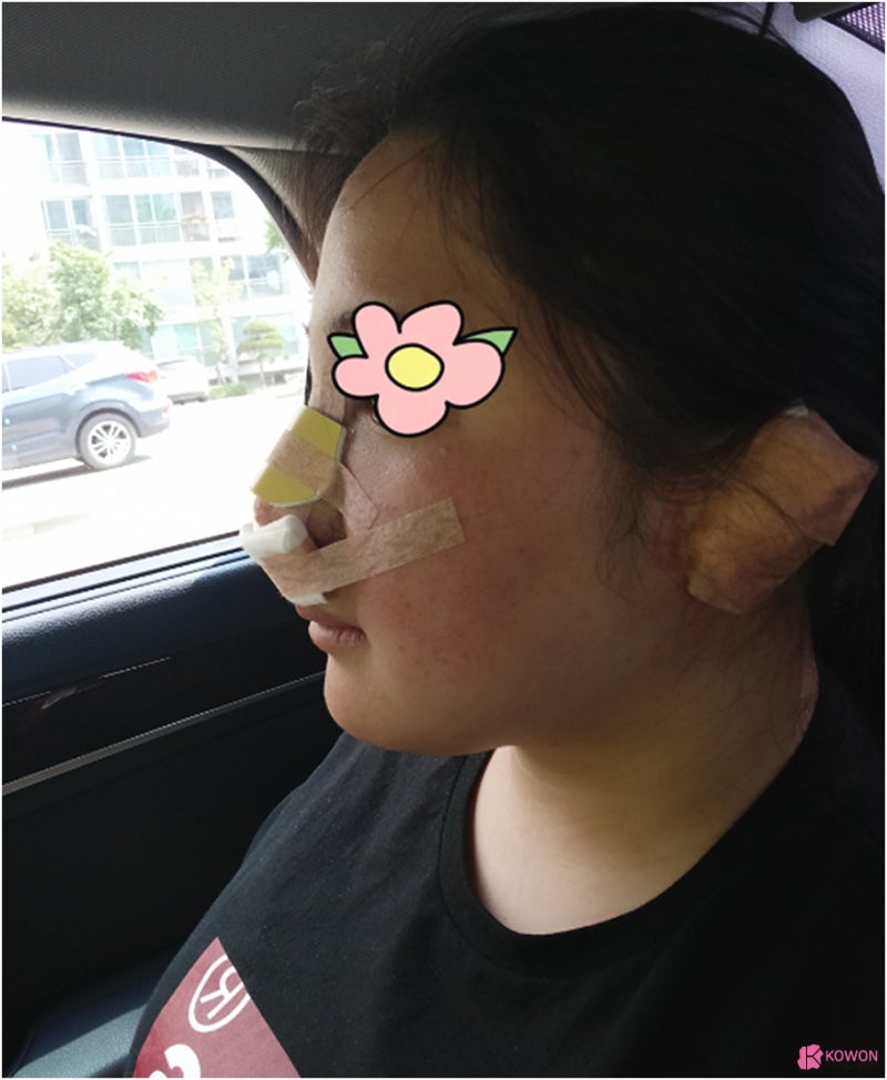 복코수술전후 코끝살 올리고 인중 라인까지 예쁘게 사진 7