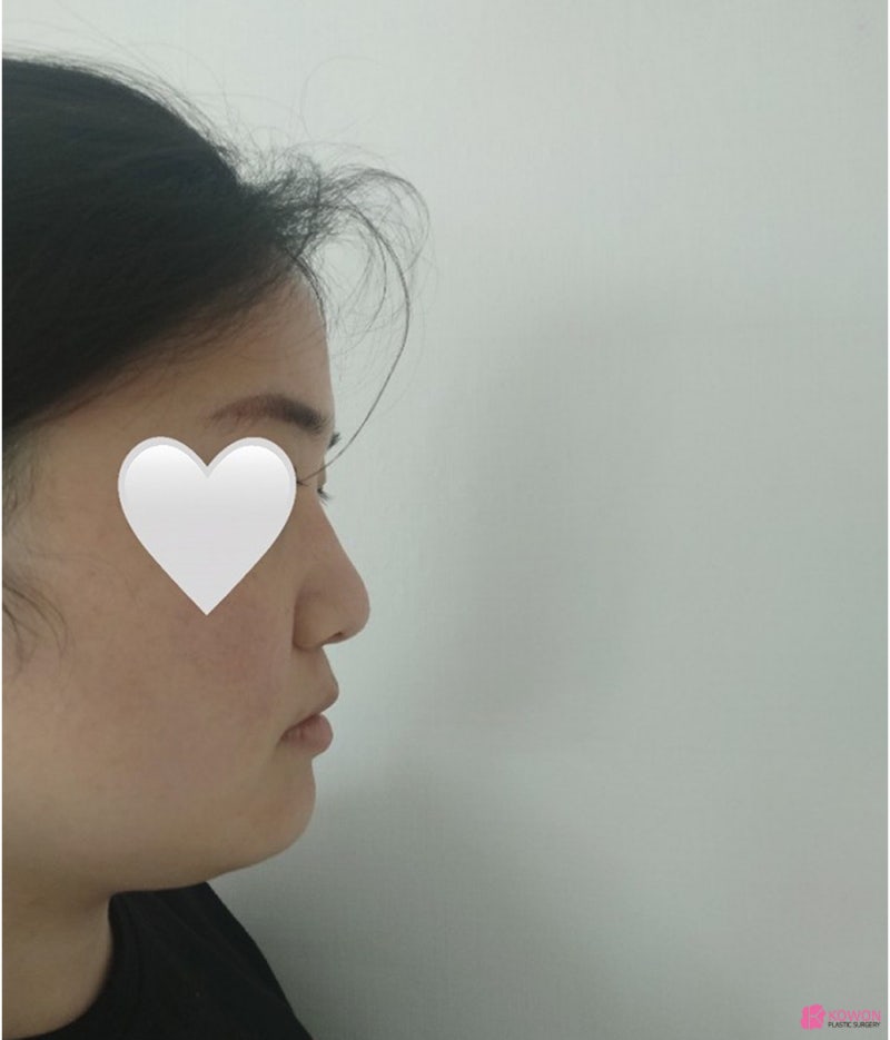 복코수술전후 코끝살 올리고 인중 라인까지 예쁘게 사진 2