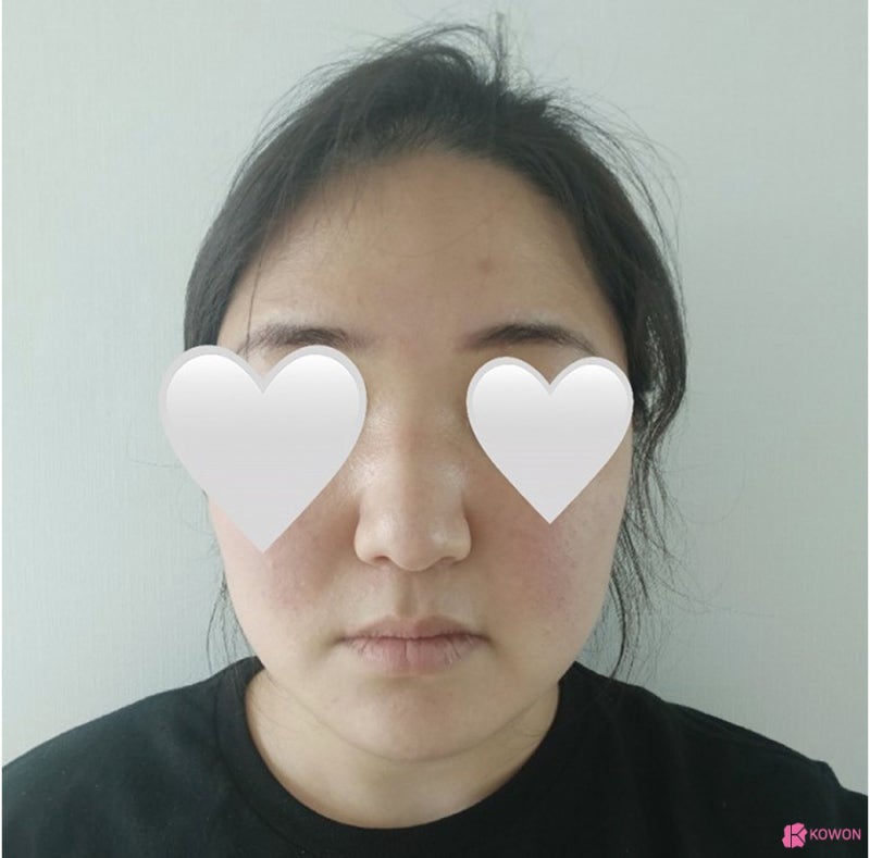 복코수술전후 코끝살 올리고 인중 라인까지 예쁘게 사진 4