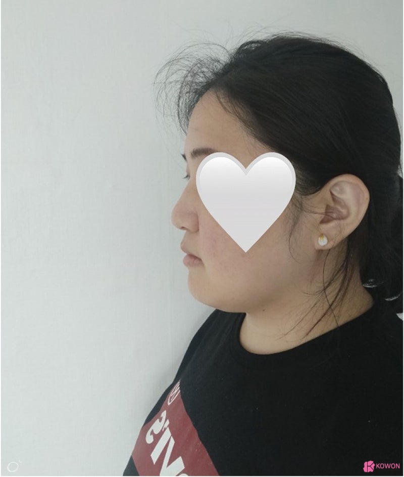 복코수술전후 코끝살 올리고 인중 라인까지 예쁘게 사진 3