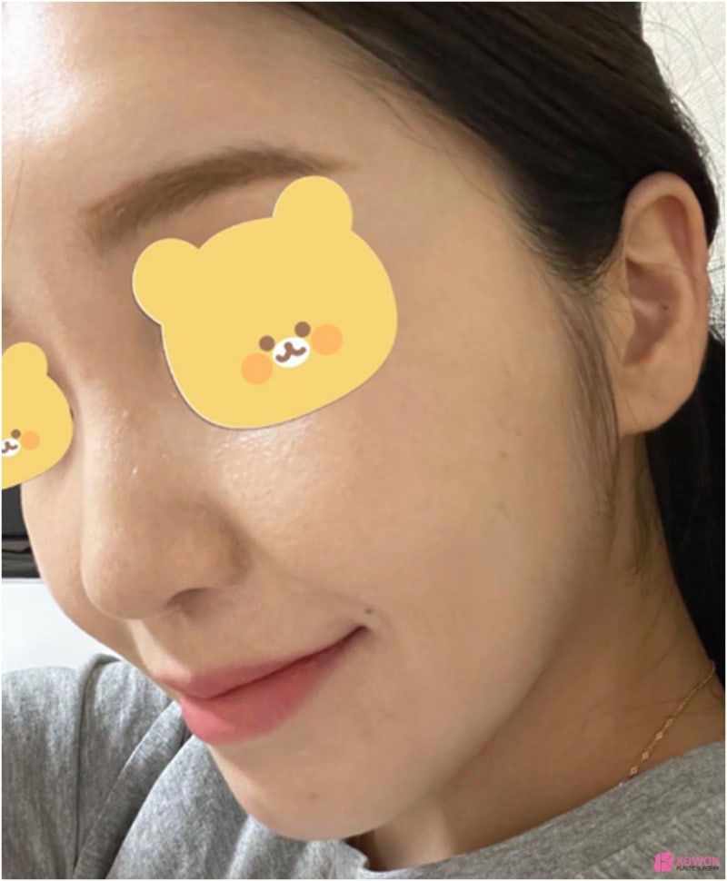 신사역성형외과 비중격휨 증상 교정 전후 사진 사진 3