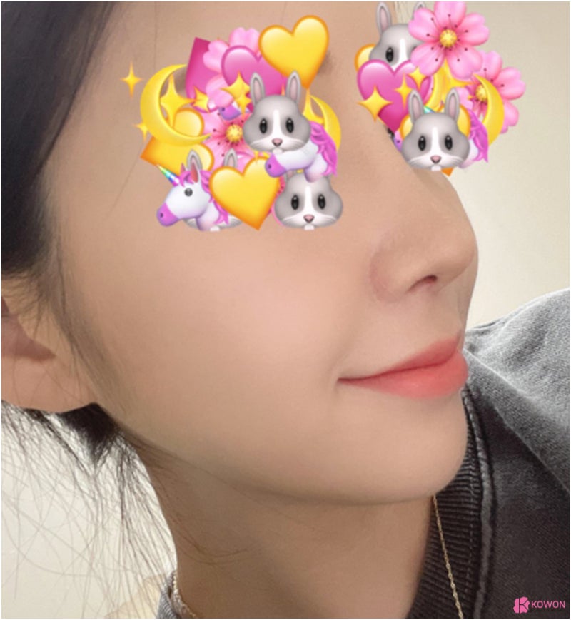 신사역성형외과 비중격휨 증상 교정 전후 사진 사진 9