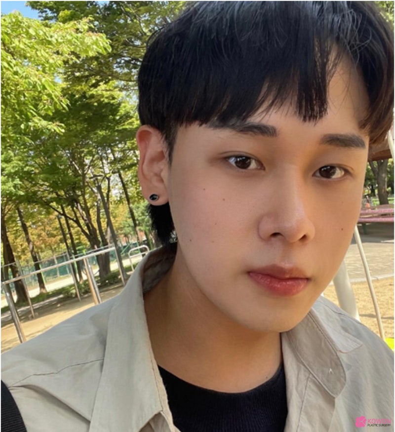 논현동성형외과 높은콧대 만들고 세련된 이미지로 사진 10
