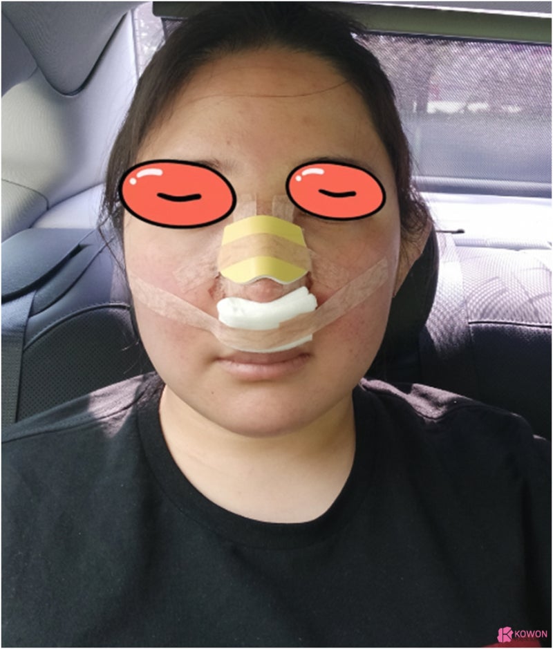 강남코수술잘하는곳 복코전후 날렵한 콧날로 변신 사진 6