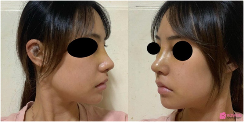 서울코성형외과 코성형비중격만곡증 해결 사례