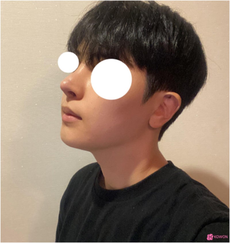 코수술병원 들창코 수술로 짝짝이 콧구멍까지 대칭으로 사진 11