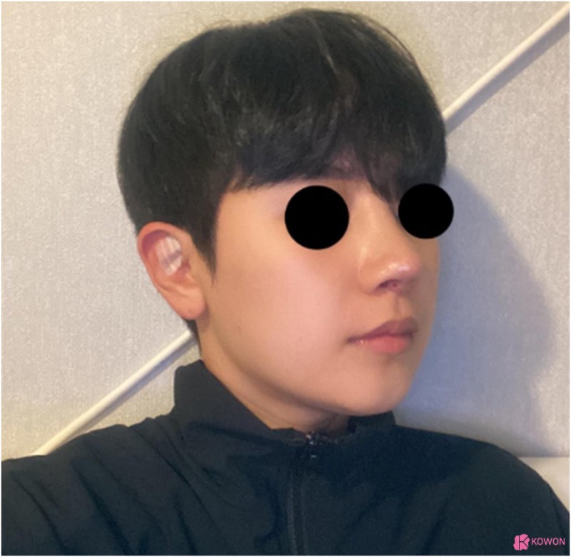 코수술병원 들창코 수술로 짝짝이 콧구멍까지 대칭으로 사진 8