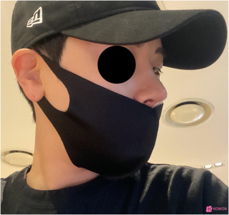 코수술병원 들창코 수술로 짝짝이 콧구멍까지 대칭으로 사진 13