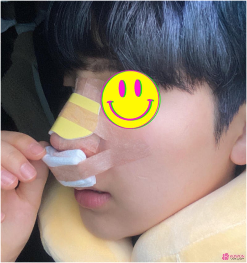 코수술병원 들창코 수술로 짝짝이 콧구멍까지 대칭으로 사진 5
