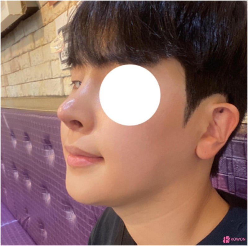 코수술병원 들창코 수술로 짝짝이 콧구멍까지 대칭으로 사진 14