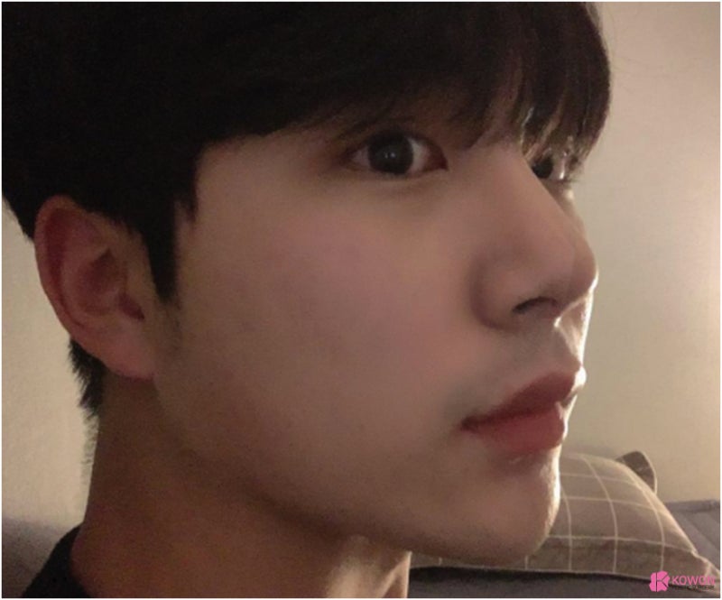 신사역코성형 코끝 모양 보완한 무보형물코수술후기 사진 11