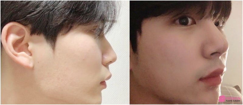 신사역코성형 코끝 모양 보완한 무보형물코수술후기