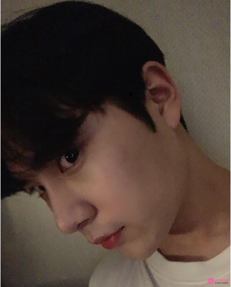 신사역코성형 코끝 모양 보완한 무보형물코수술후기 사진 8