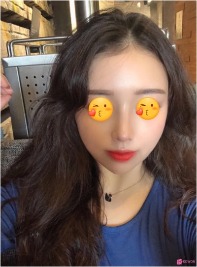 강남코성형잘하는곳 낮은코 높이고 입체감 생긴 얼굴 사진 5