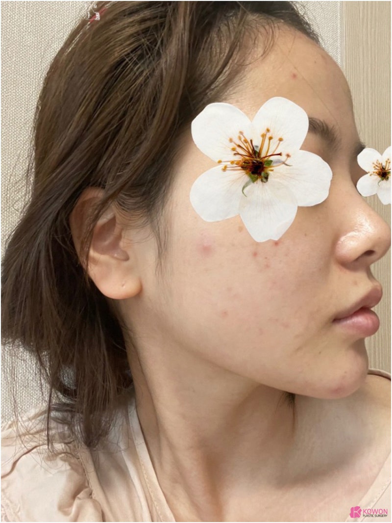 코성형잘하는곳추천 신세경코 여성스러운 이미지를 원한다면 사진 4