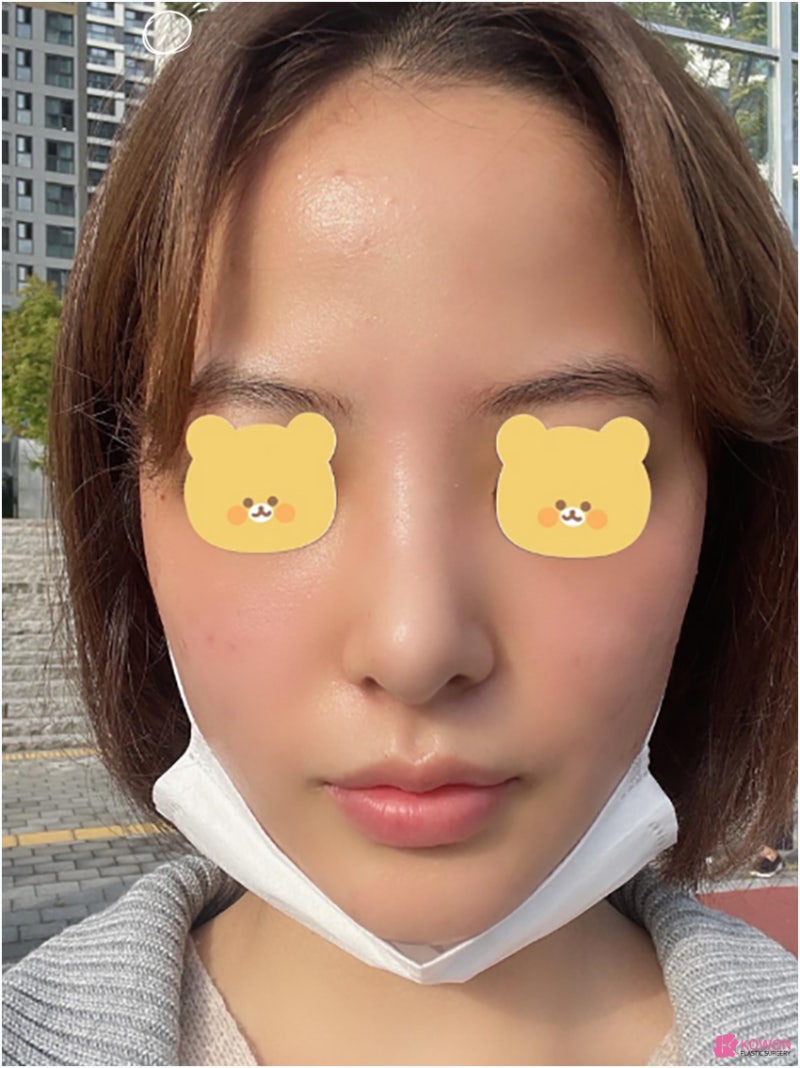 코성형잘하는곳추천 신세경코 여성스러운 이미지를 원한다면 사진 10