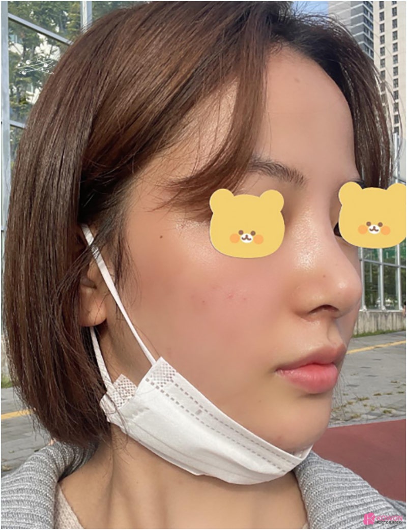 코성형잘하는곳추천 신세경코 여성스러운 이미지를 원한다면 사진 8