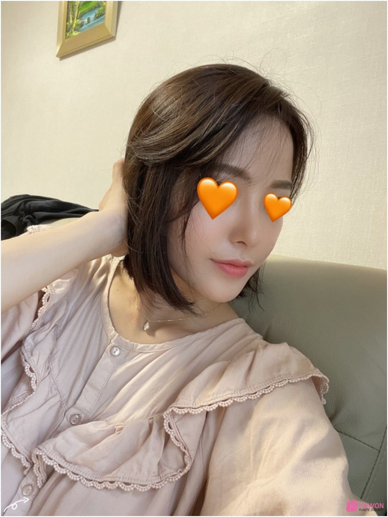 코성형잘하는곳추천 신세경코 여성스러운 이미지를 원한다면 사진 11