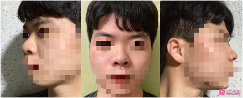 코성형유명한병원 자가 늑연골 활용한 남자복코수술 통해 개선