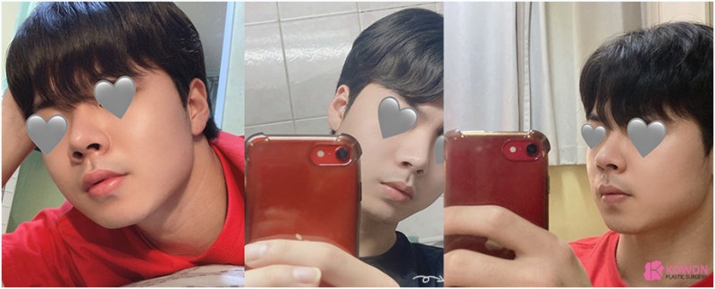 코성형유명한병원 자가 늑연골 활용한 남자복코수술 통해 개선 사진 10