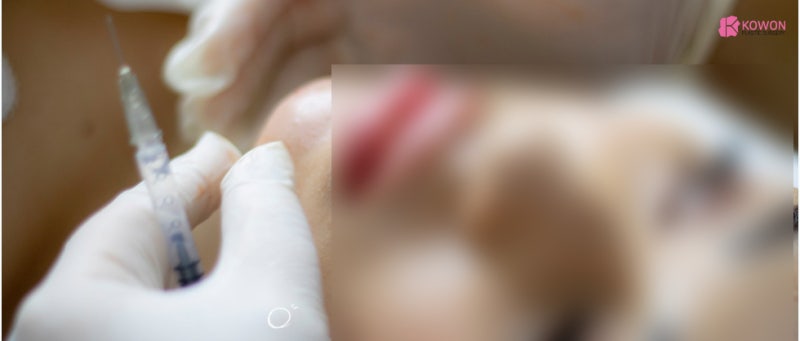 코 수술 후 필러 가능 여부 비추천 이유 사진 9