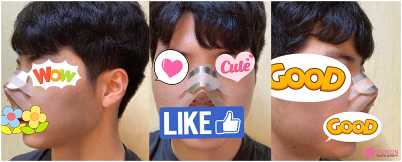 큰코수술후기 자연스러운코성형 잘하는 곳 사진 4