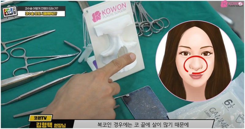 성형시뮬레이션 통해 알아보는 매부리코교정 방법 사진 10