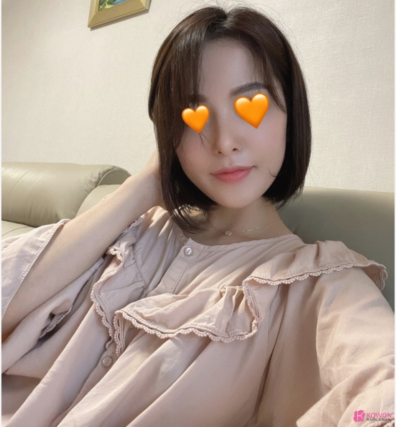 직반버선코수술 세련된 모양으로 코콤플렉스 탈출 사진 12