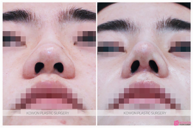 복코성형후기 낮은 미간 두꺼운 피부 코수술과정 전후 사진 4