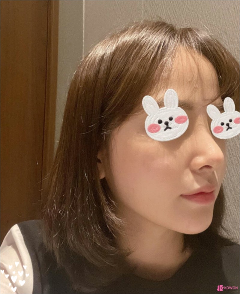 신사역코성형외과 조화로운 작은코성형 후기 사진 5