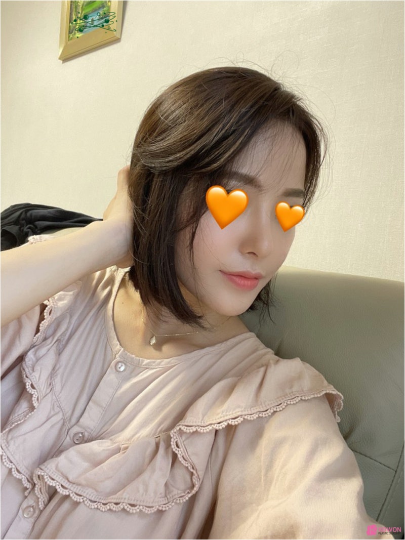 신사역코성형외과 조화로운 작은코성형 후기 사진 11