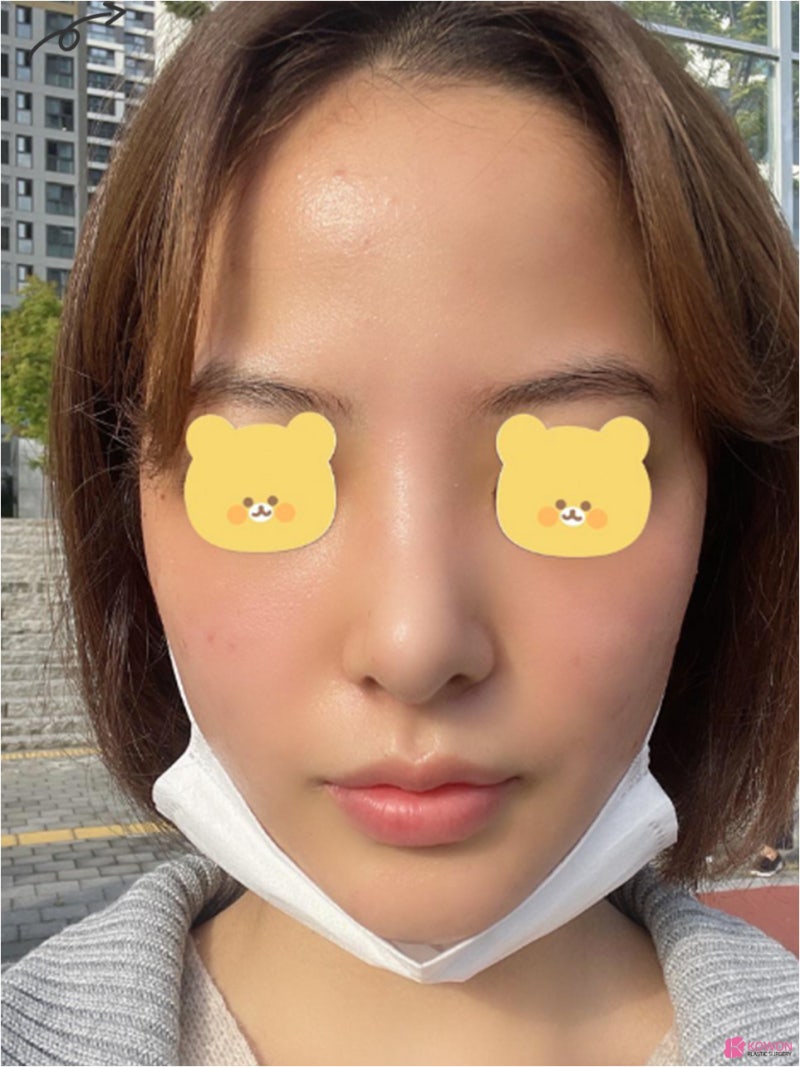 신사역코성형외과 조화로운 작은코성형 후기 사진 10
