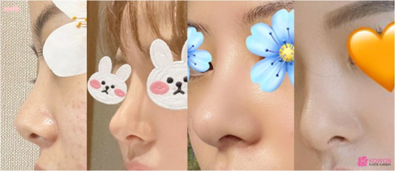 신사역코성형외과 조화로운 작은코성형 후기 사진 14