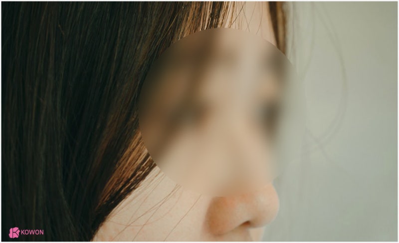 콧구멍 염증 콧속 이물질 생기는 이유 치료방법 사진 4