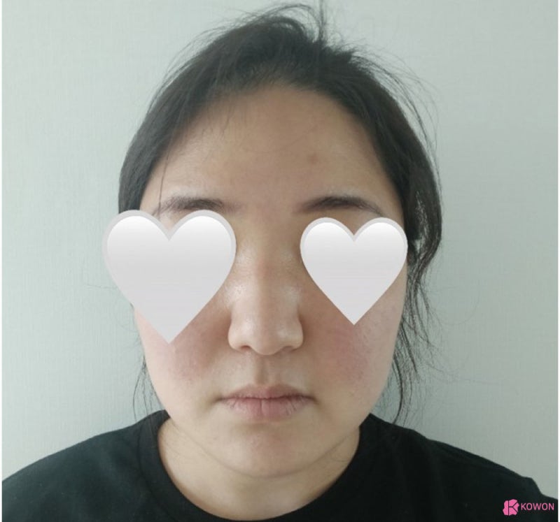 여자복코 후기 강남신사성형외과 통해 세련된 이미지로 사진 4
