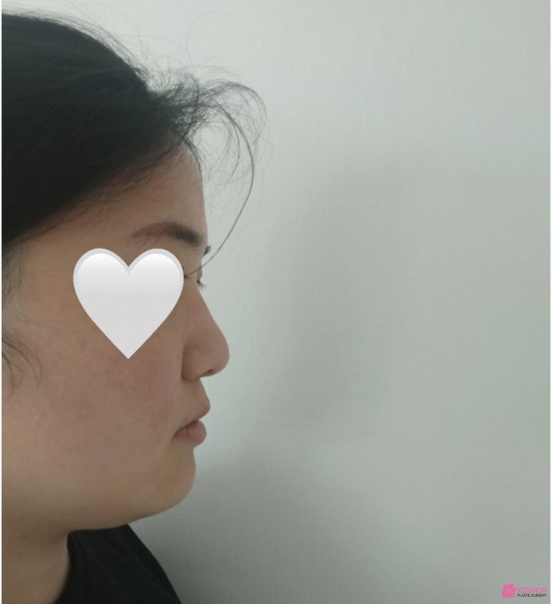 여자코성형후기 코끝수술방법 동글동글한 이미지 변화