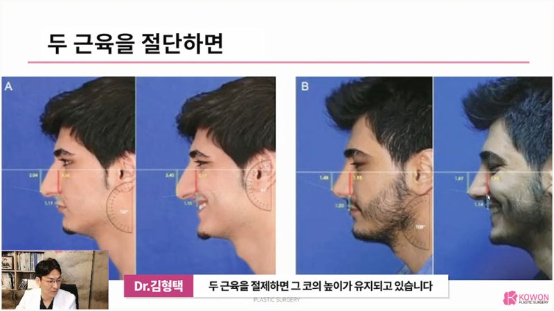 강남코성형외과 추천하는 화살코교정 방법 소개 사진 8