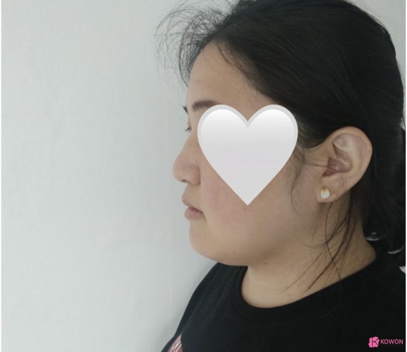 복코콧대 만드는 방법 가로수길성형외과 사진 3