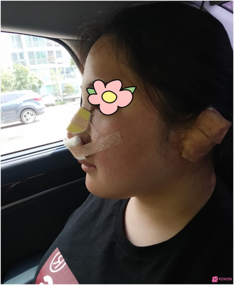 복코콧대 만드는 방법 가로수길성형외과 사진 7