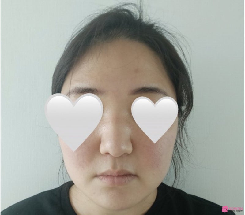 복코콧대 만드는 방법 가로수길성형외과 사진 4