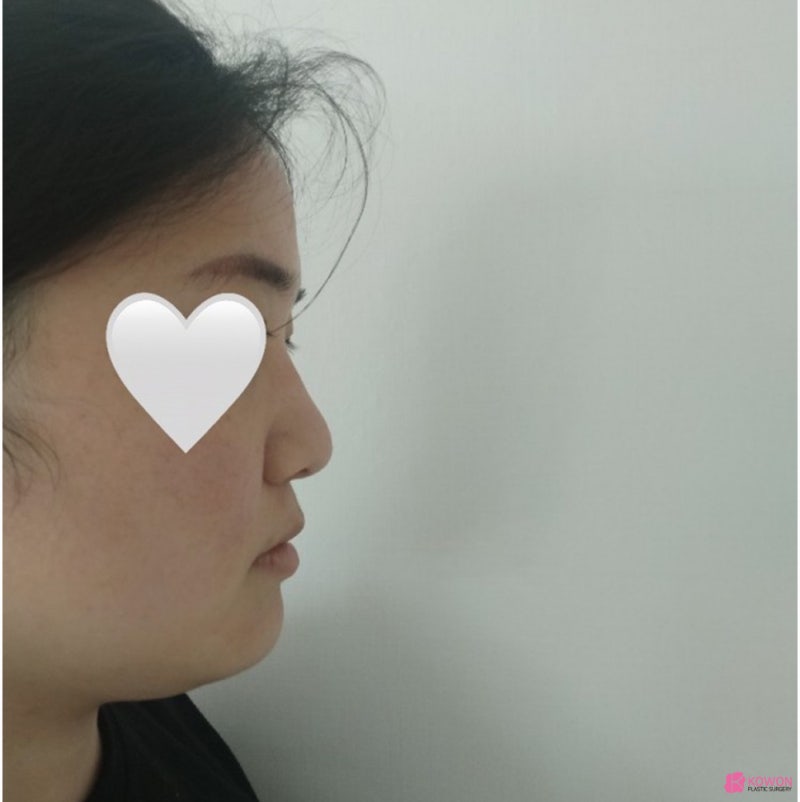 복코콧대 만드는 방법 가로수길성형외과