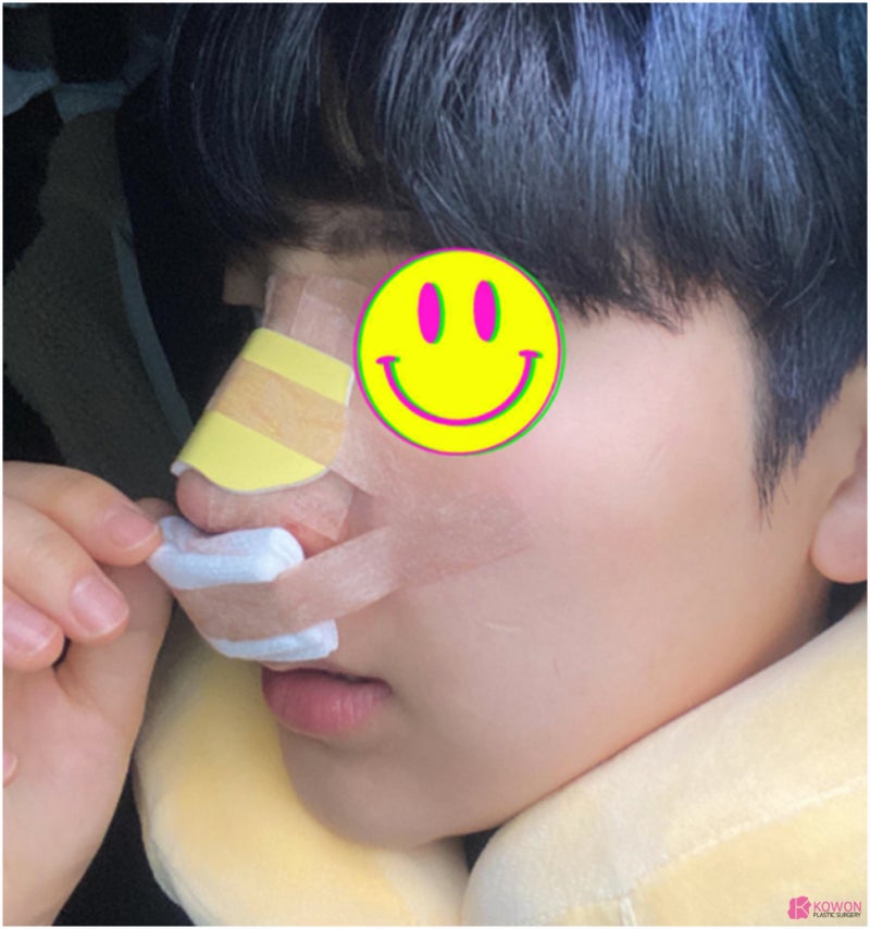 콧구멍보이는코 재수술 남성 환자 역삼성형외과 사진 5