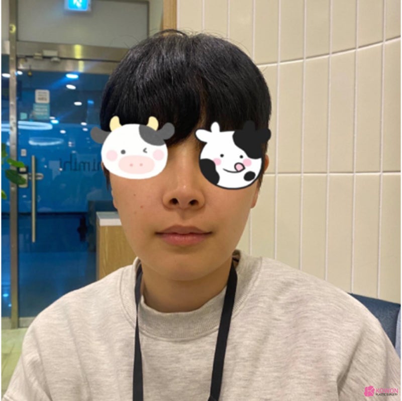 콧구멍보이는코 재수술 남성 환자 역삼성형외과 사진 3